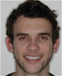 face view after procedures: correct migranes, headaches, sleep apnea, bruxing and tmj problems