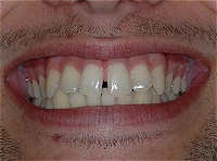 teeth before procedures: correct sleep apnea, headaches, migranes, bruxing and tmj problems